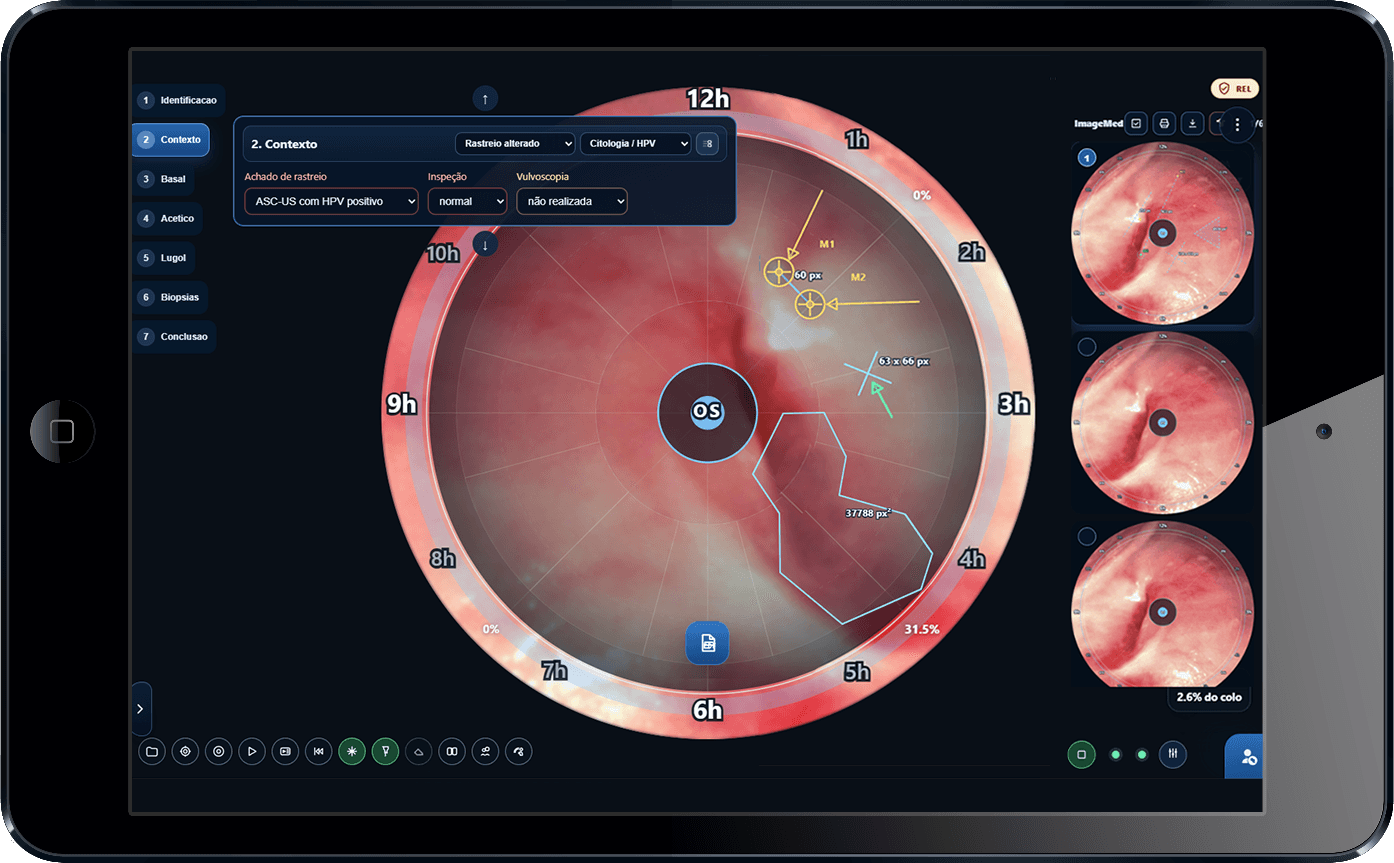 RMColpo tablet workspace with cervix map, contextual findings, and protocol-driven steps.